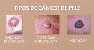 Novo tratamento contra o câncer de pele pode entrar no SUS